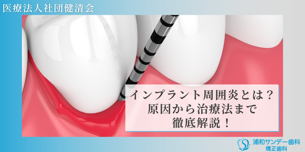 インプラント周囲炎とは？原因から治療法まで徹底解説！